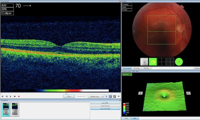 AI của DeepMind đang phân tích hình ảnh quét OCT (Ảnh DeepMind). AI của DeepMind đang phân tích hình ảnh quét OCT (Ảnh DeepMind).