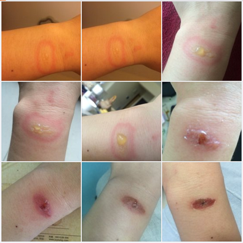 Hình ảnh cánh tay bị bỏng do đeo Mi Band 2 được người dùng Trung Quốc đăng tải- (Ảnh chụp màn hình).