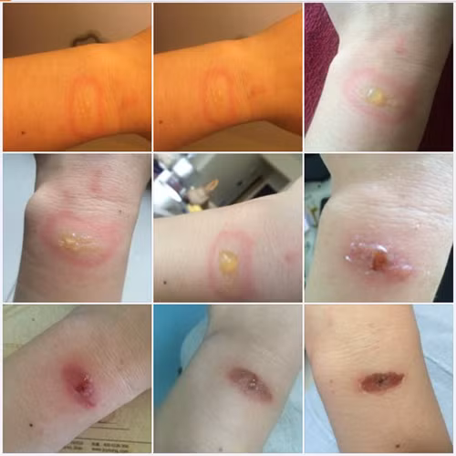 Hình ảnh cánh tay bị bỏng do đeo Mi Band 2 được người dùng Trung Quốc đăng tải- (Ảnh chụp màn hình).