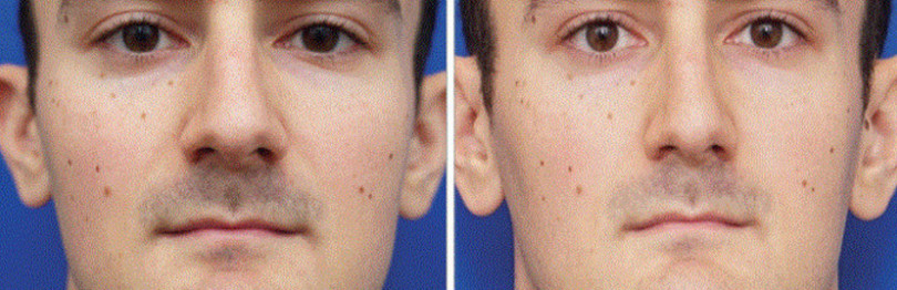 Chụp ảnh tự sướng nhiều sẽ làm mũi bị to ra? ảnh 1