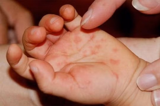 Đà Nẵng yêu cầu tăng cường phòng chống bệnh tay chân miệng