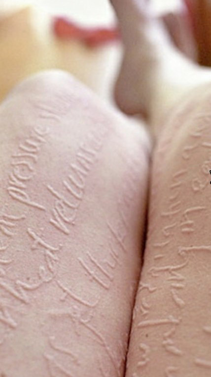 Da vẽ nổi còn được gọi là da viết chữ, không ảnh hưởng đến tính mạng nhưng rất dễ trở thành mãn tính (ảnh minh họa)