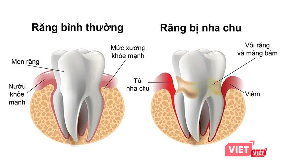 Mất răng do bệnh nha chu (Ảnh: cung cấp) 