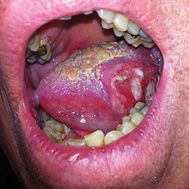 Ung thư lưỡi (Ảnh: Minh họa)
