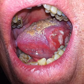 Ung thư lưỡi Ung thư lưỡi (Ảnh: Minh họa)
