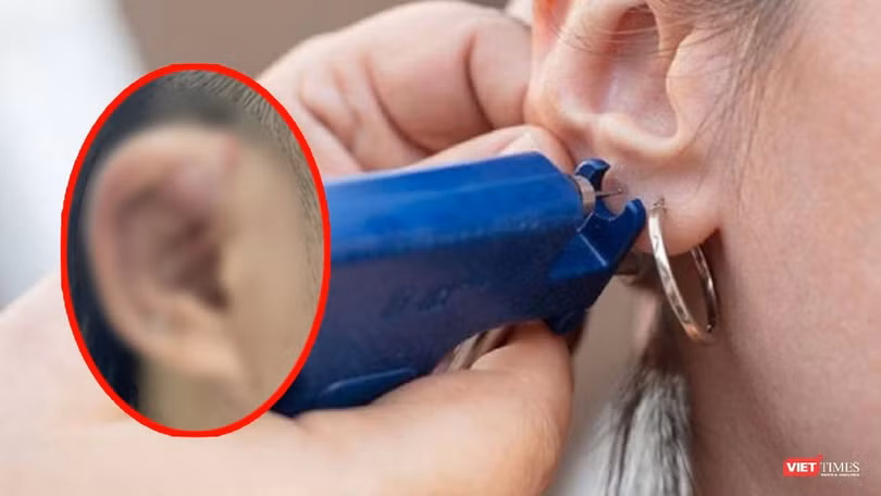 Bệnh nhân bị biến chứng do bấm lỗ tai sai vị trí, không đảm bảo vệ sinh