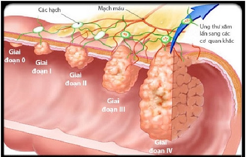 Các giai đoạn phát triển ung thư phổi. Ảnh: Phụ nữ Online