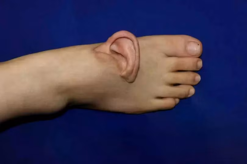 Chiếc tai đã được cấy ghép vào bàn chân của bệnh nhân trong nhiều tháng. Ảnh: QQ.