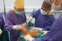 Các bác sĩ phẫu thuật cho bệnh nhân (Ảnh - BVCC) 