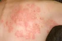 Viêm da cơ địa 