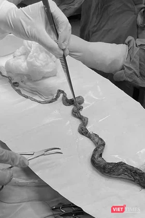 Búi tóc lấy ra từ dạ dày bé trai 6 tuổi