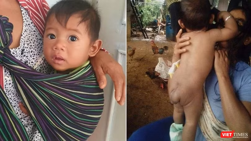 Bé trai 7 tháng tuổi người dân tộc Châu Mạ mang khối u khổng lồ ở mông