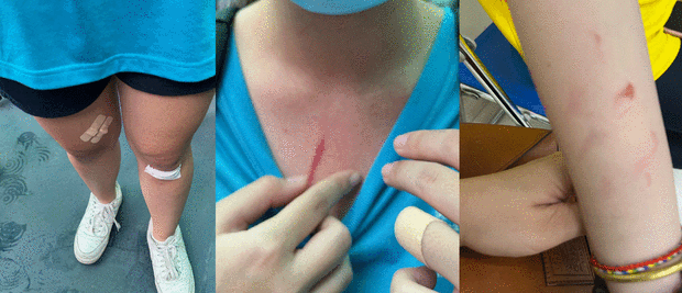 Một học sinh bị thương trong lúc xô xát