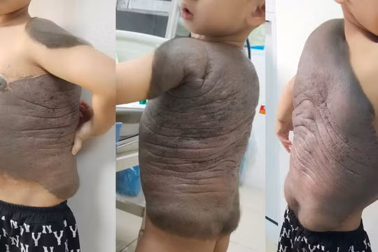 Cậu bé mang trên mình khối u rất lớn