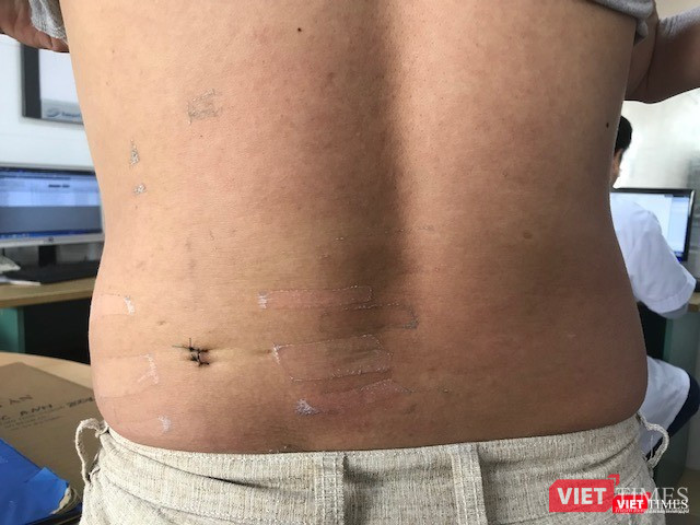 Sau mổ, bệnh nhân hoàn toàn khỏe mạnh, vết mổ nhỏ, ít xâm lấn Sau mổ, bệnh nhân hoàn toàn khỏe mạnh, vết mổ nhỏ, ít xâm lấn