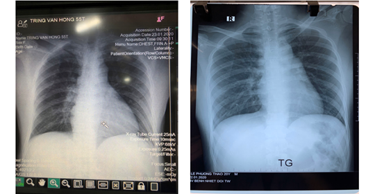 Ảnh chụp X quang của 2 bệnh nhân. Ảnh Bệnh viện Bệnh nhiệt đới Trung ương cơ sở 2
