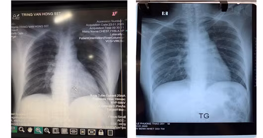 Ảnh chụp X quang của 2 bệnh nhân. Ảnh Bệnh viện Bệnh nhiệt đới Trung ương cơ sở 2