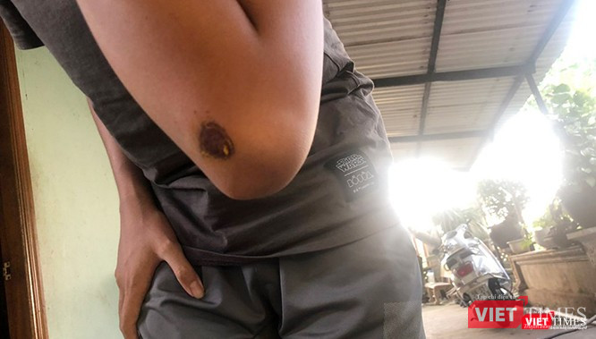 Nạn nhân bị thương. Nạn nhân bị thương.