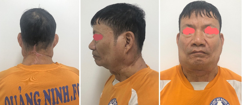 Bệnh nhân sau 3 lần mổ đã trở lại dáng vẻ bình thường