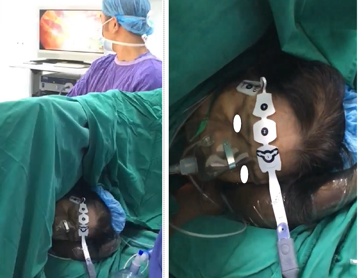 Bệnh nhân phẫu thuật bằng phương pháp gây mê không cần thở máy