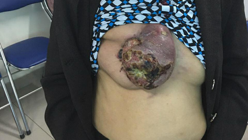 Bệnh nhân ung thư vú tự đắp lá 