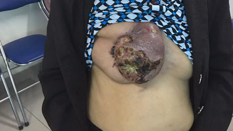 Bệnh nhân ung thư vú tự đắp lá 