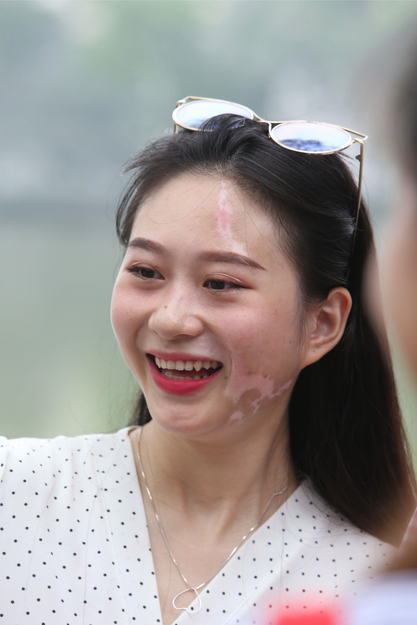 Bệnh bạch biến vẫn chưa có thuốc điều trị khỏi hoàn toàn