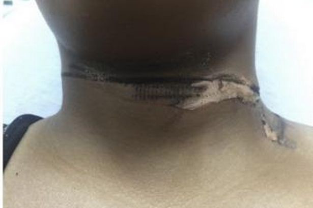 Cô gái bị bỏng cấp độ 2 khi dùng cáp sạc đểu