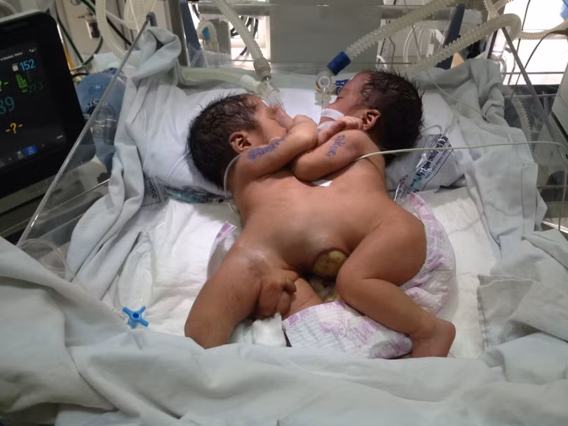 Cặp song sinh dính nhau ở Hà Giang năm 2016