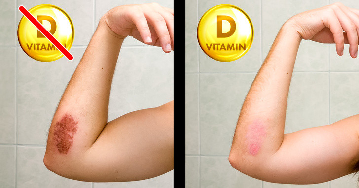 8 dấu hiệu của cơ thể nhắc nhở bạn cần bổ sung ngay vitamin D ảnh 6