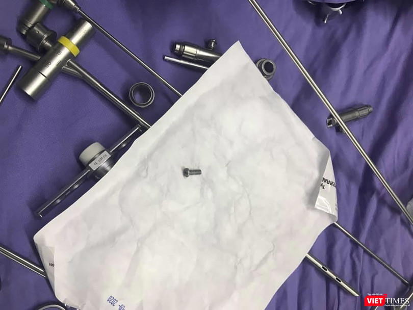 Đinh vít nằm ở đường thở của bệnh nhân nhi tên N. ở Quảng Nam sau khi nội soi gắp ra.