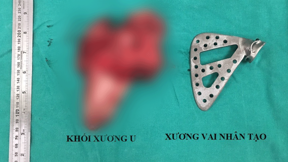 Khớp xương vai nhân tạo do các bác sĩ liên hệ giúp cô giáo Th. thoát cảnh tàn phế (Ảnh: Bác sĩ Phạm Sơn Tùng)