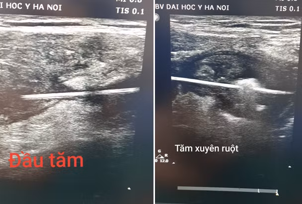 Hình ảnh chiếc tăm trong bụng bệnh nhân. (Ảnh: Bệnh viện Đại học Y Hà Nội)
