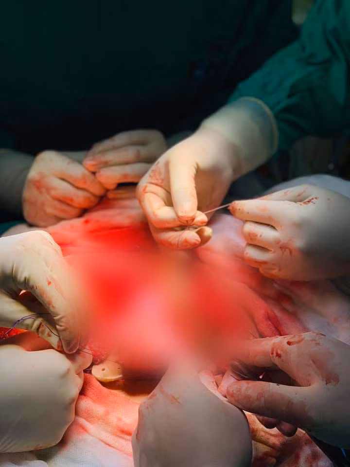 Ca mổ thay xương bả vai đã diễn ra thành công (Ảnh: PGS. TS. Trần Trung Dũng)