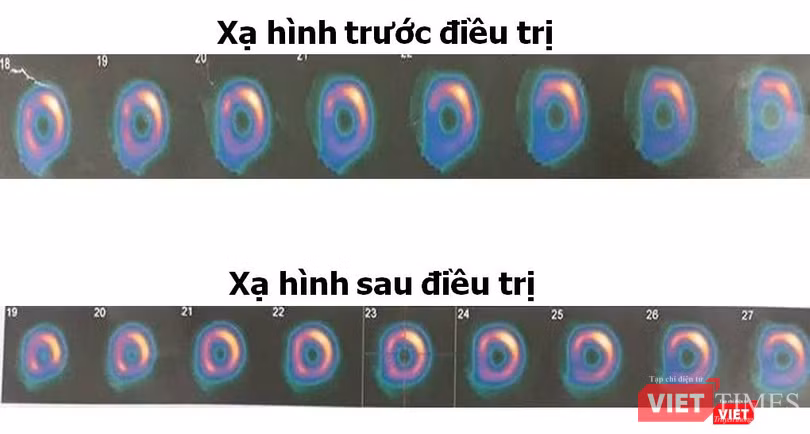 Chụp xạ hình cơ tim sau trị liệu thấy cải thiện mức độ sống còn cơ tim