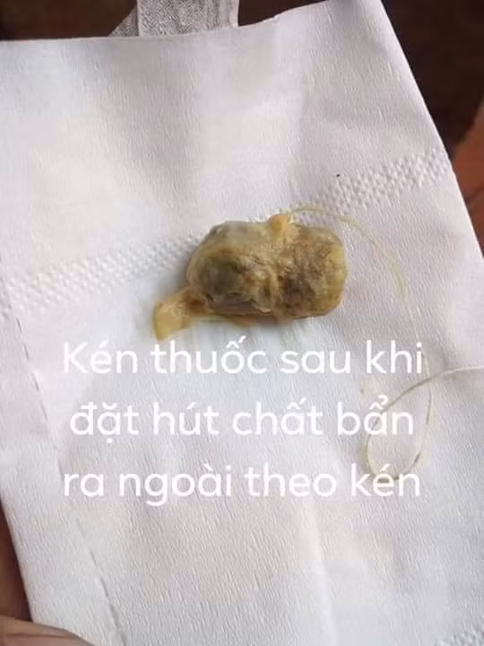 Kén thuốc sau khí sử dụng (Ảnh: FB H.T) Kén thuốc sau khí sử dụng (Ảnh: FB H.T)