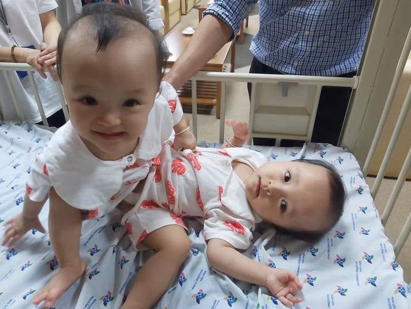Cặp song sinh được chăm sóc tại Bệnh viện Nhi đồng Thành phố (Ảnh: Bệnh viện Nhi đồng TP.HCM)