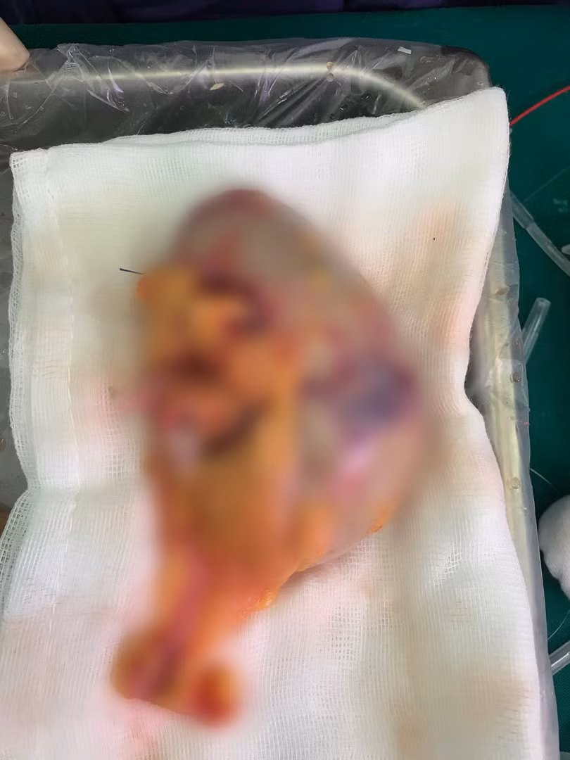 Quả thận trái của bệnh nhân được làm sạch trước khi ghép (Ảnh: Bệnh viện Hữu nghị Việt Đức) Quả thận trái của bệnh nhân được làm sạch trước khi ghép (Ảnh: Bệnh viện Hữu nghị Việt Đức)