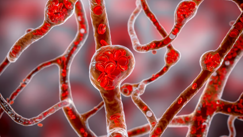 Kim Kardashian tiết lộ bị phình mạch não Mức độ nguy hiểm ra sao, điều trị như thế nào 2.png