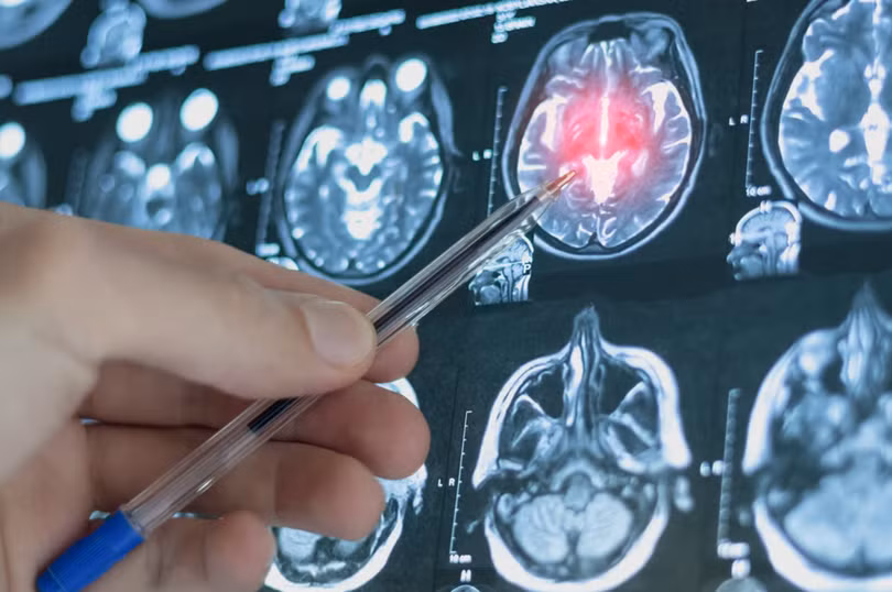 Kim Kardashian tiết lộ bị phình mạch não Mức độ nguy hiểm ra sao, điều trị như thế nào 4.png