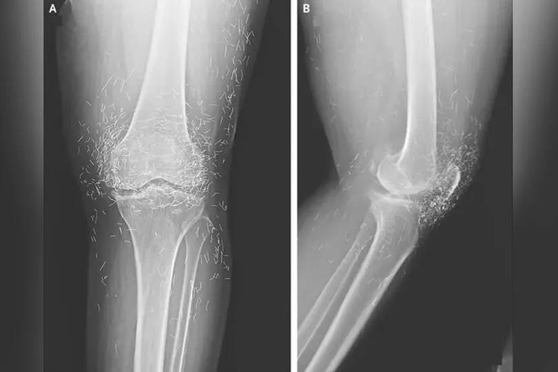 Ảnh chụp X-quang cho thấy hàng trăm sợi chỉ vàng trong đầu gối của nữ bệnh nhân. Ảnh: OddCentral.