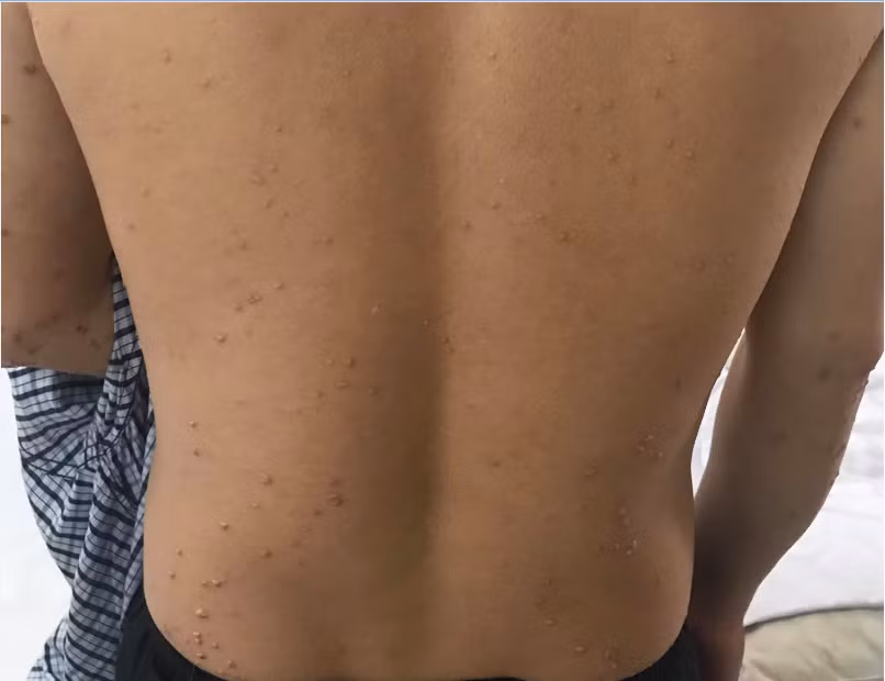 Khi mắc u vàng phát ban, các nốt sần sẽ xuất hiện khắp cơ thể kèm theo bệnh lý đái tháo đường Khi mắc u vàng phát ban, các nốt sần sẽ xuất hiện khắp cơ thể kèm theo bệnh lý đái tháo đường