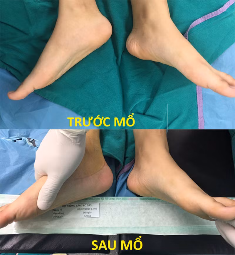 Mãi tới lần thứ 3 phẫu thuật, bệnh của C. mới được chữa khỏi, đồng thời, khắc phục dáng đi khác thường của em.
