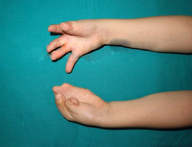 Bàn tay trái của T. bị dị tật dính liền 5 ngón Bàn tay trái của T. bị dị tật dính liền 5 ngón
