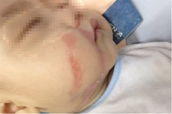 Trẻ nhỏ dễ bị bỏng vì hiếu động và tính tò mò Trẻ nhỏ dễ bị bỏng vì hiếu động và tính tò mò