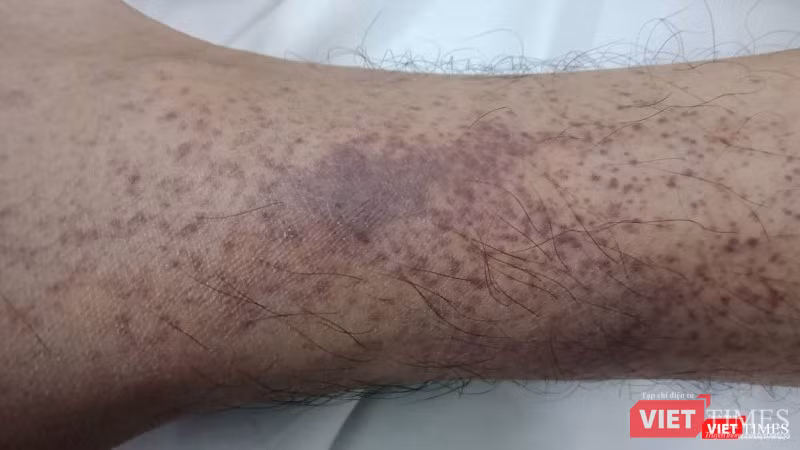 Tình trạng xuất huyết nặng dươi da của một bệnh nhân mắc sốt xuất huyết trên nền bệnh tan máu bẩm sinh -Thalassemia - tại Bệnh viện Bạch Mai. Tình trạng xuất huyết nặng dươi da của một bệnh nhân mắc sốt xuất huyết trên nền bệnh tan máu bẩm sinh -Thalassemia - tại Bệnh viện Bạch Mai.