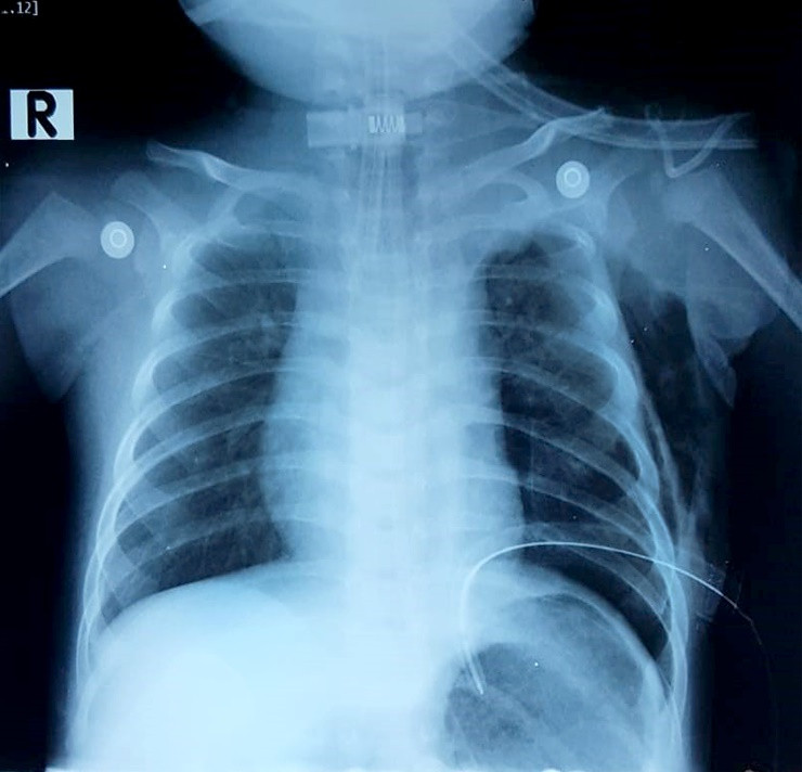 Hình ành chụp X quang cho thấy bệnh nhi bị rò dịch dưỡng trấp nghi do rò từ ống ngực vào khoang màng phổi. Ảnh: BVCC