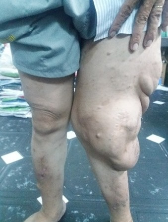 Bệnh nhân Ph.Tr.M. mang khối u bướu thần kinh khổng lồ suốt 20 năm. Ảnh: BVCC