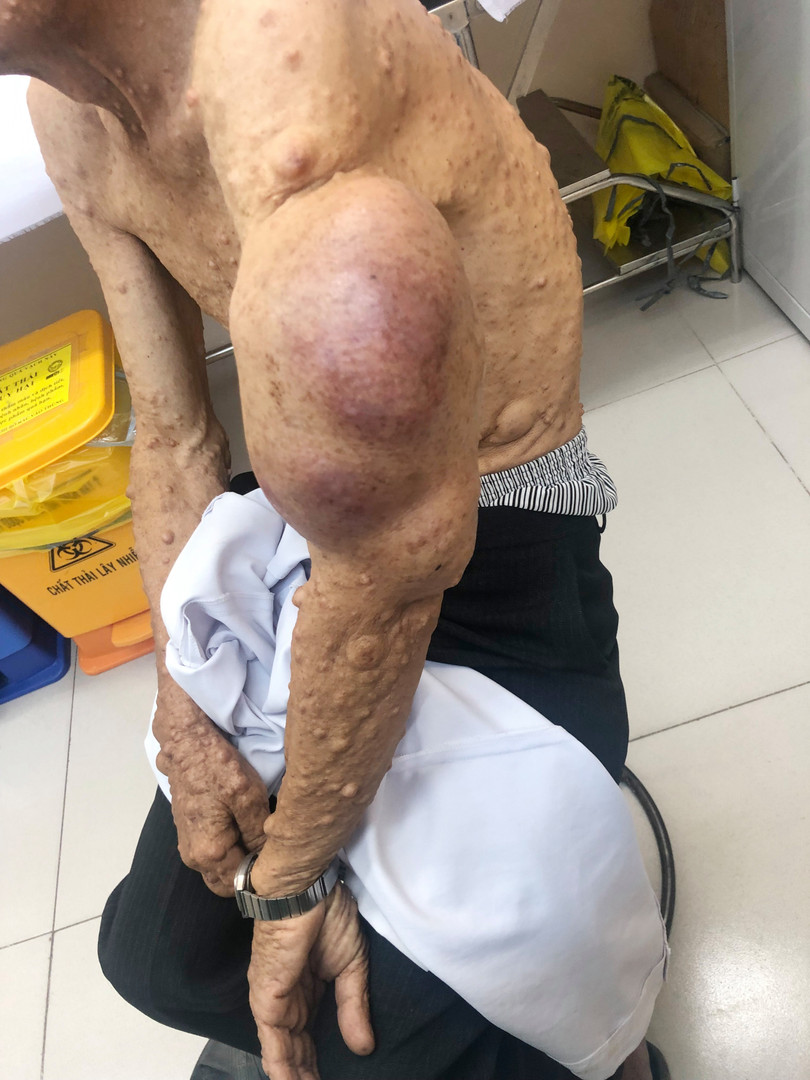 Bệnh nhân Đ.V.H. bị khối bướu thần kinh ở cánh tay suốt mấy chục năm trời, gây nhiều khó khăn trong sinh hoạt và mỗi ngày thêm đau nhức. Ảnh: BVCC