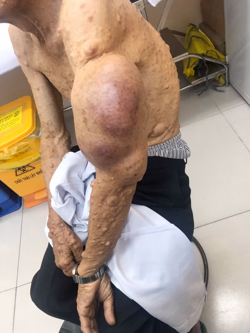 Bệnh nhân Đ.V.H. bị khối bướu thần kinh ở cánh tay suốt mấy chục năm trời, gây nhiều khó khăn trong sinh hoạt và mỗi ngày thêm đau nhức. Ảnh: BVCC